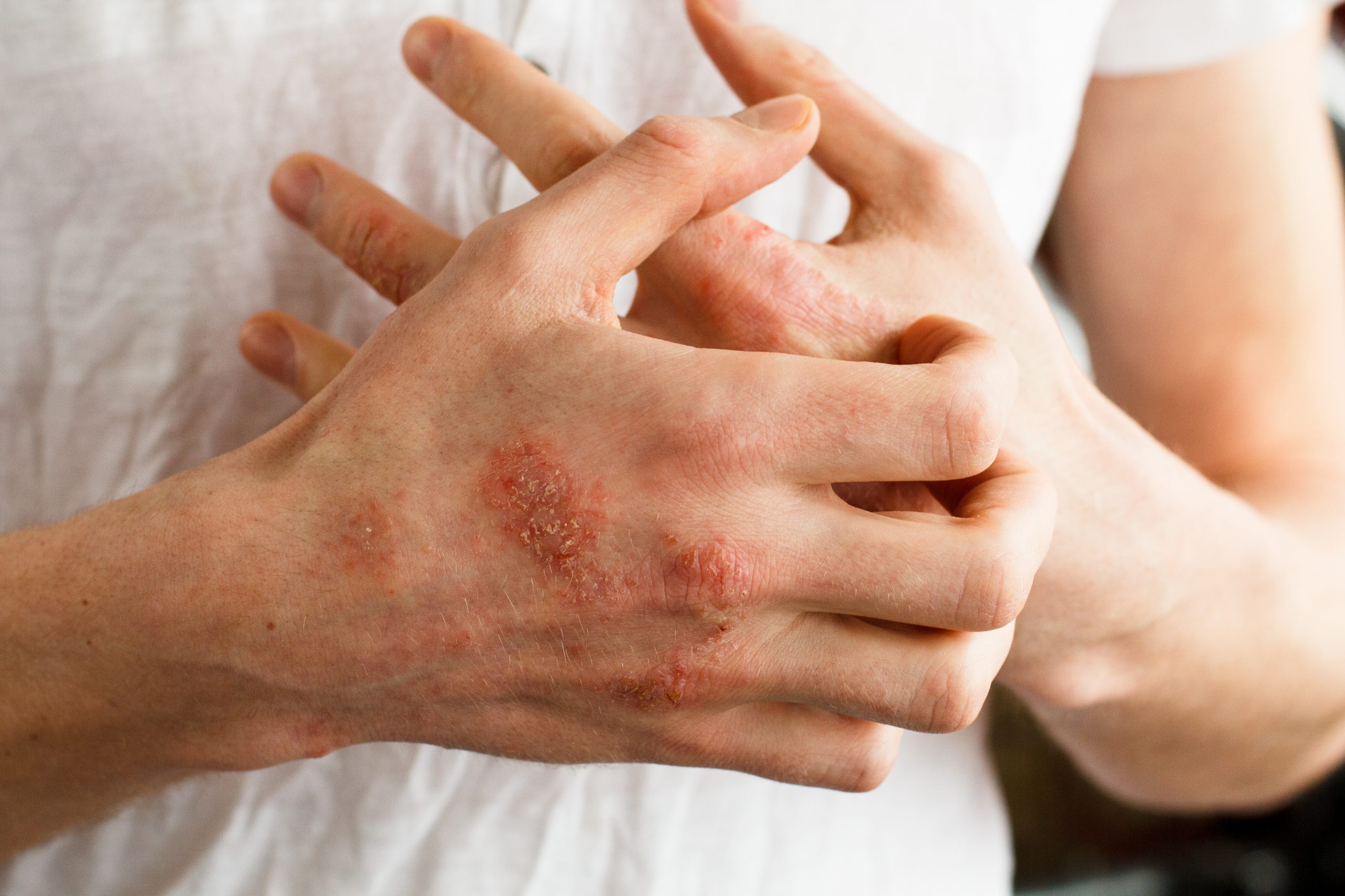 Psoriasis Hand