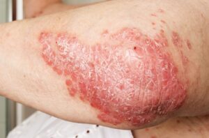 Psoriasis oder Ekzem